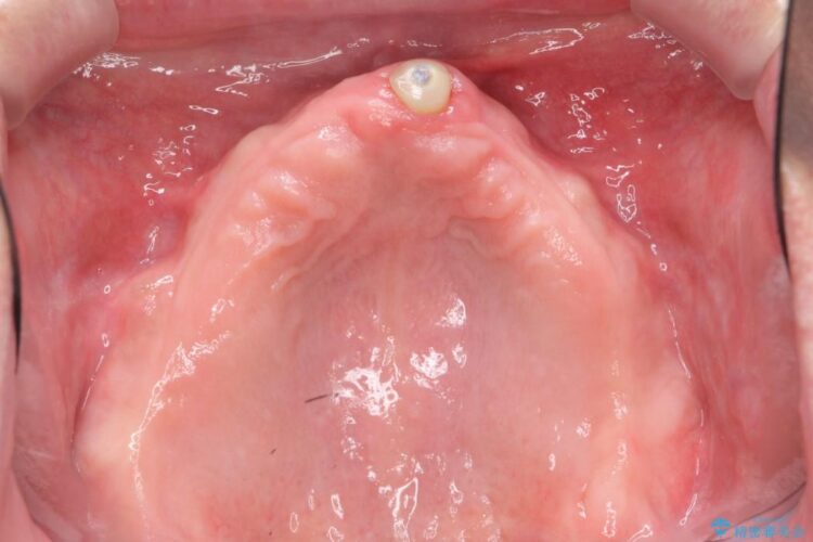 【50代男性】重度の歯周病をインプラントを用いた上顎義歯（入れ歯）で補綴治療 治療前画像