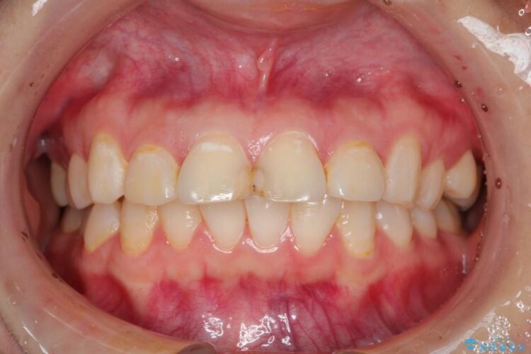 【20代女性】出っ歯の矯正 治療例 治療前画像