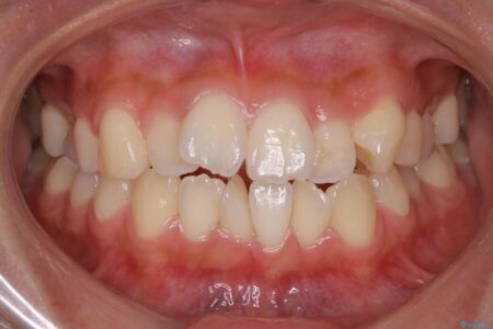 【20代女性】前歯の真ん中（正中）のズレとガタつきを効率よく矯正する 治療前