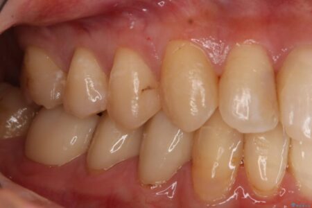 【20代 女性】劣化した保険のプラスチックをセラミックへ 治療前