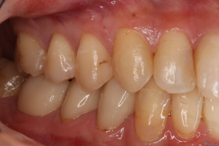 【20代 女性】劣化した保険のプラスチックをセラミックへ 治療前画像