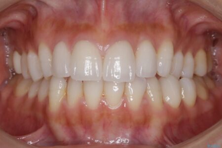 【30代女性】噛み合わせのズレを解消する 治療前