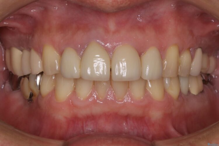 【50代男性】前歯の被せ物を新しく 治療前画像