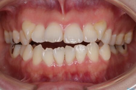 【30代女性】インビザラインで抜歯矯正 治療前