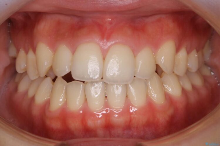 【20代女性】噛み合わせの歪みを超短期間でインビザライン治療 治療前画像