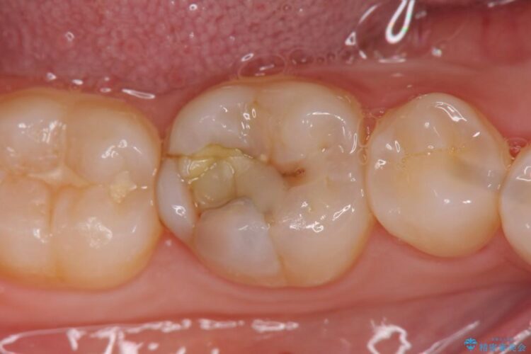 【20代女性】黒ずんだ虫歯をとり白い歯へ ビフォー