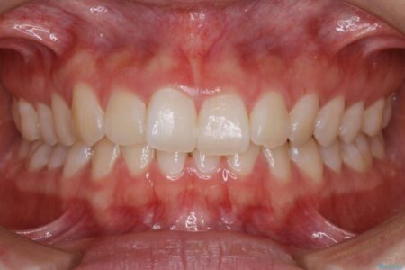 【20代女性】噛み合わせのズレからくるガタついた歯列をインビザライン矯正治療 治療前