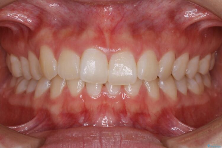 【20代女性】噛み合わせのズレからくるガタついた歯列をインビザライン矯正治療 治療前画像