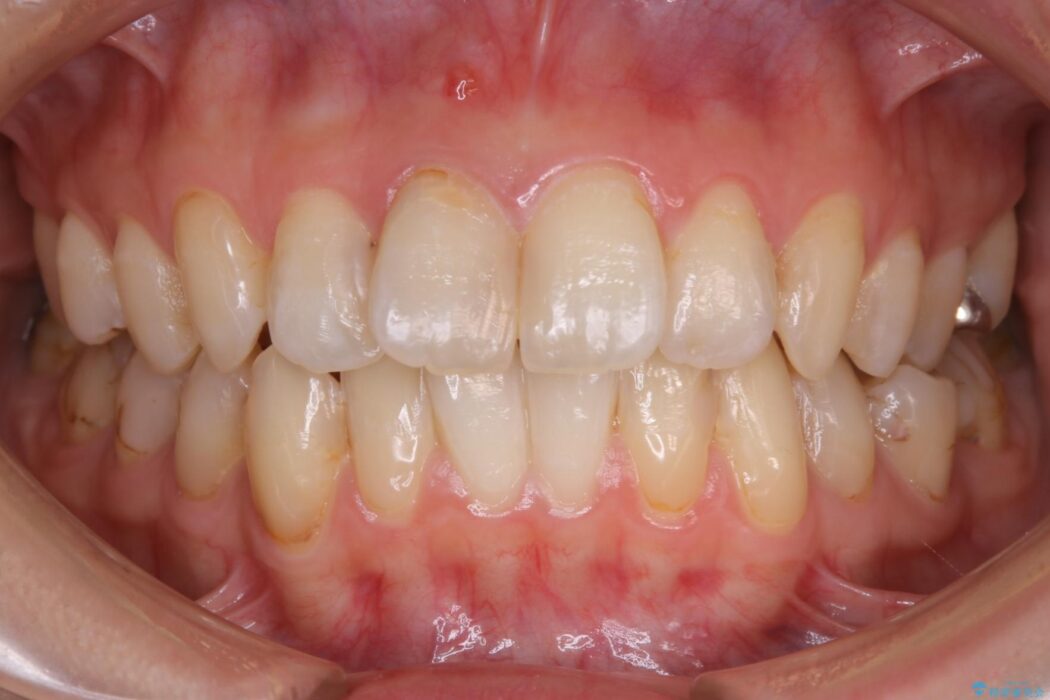 【20代女性】非抜歯で歯列をコンパクトに 治療前