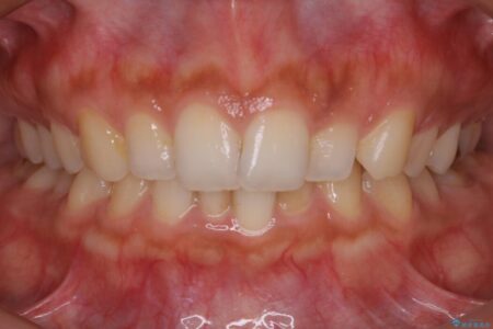 【20代女性】ゴムかけを併用し噛み合わせを改善!インビザライン矯正 治療前