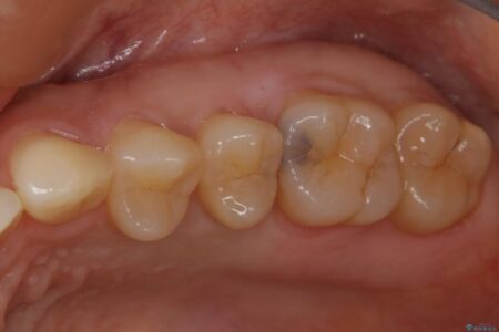 【30代女性】黒ずんだ虫歯をセラミック治療 治療前