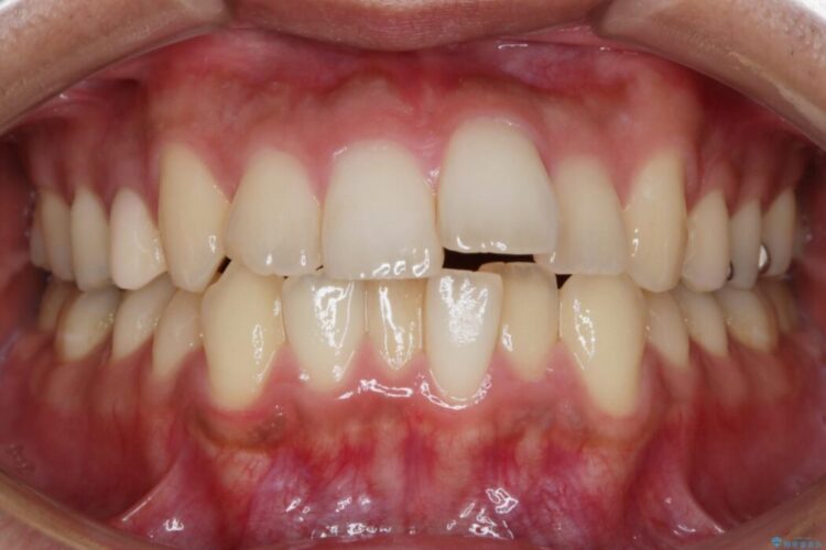 【20代男性】出っ歯をインビザラインで矯正治療 治療前画像