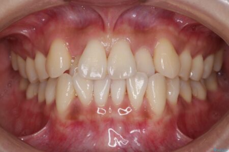 【20代女性】抜歯無しで前歯のがたがたを改善する 治療前