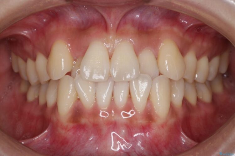 【20代女性】抜歯無しで前歯のがたがたを改善する 治療前画像