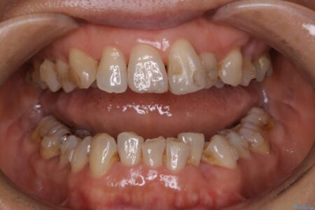 【40代女性】インビザライン治療中のクリーニング 治療前
