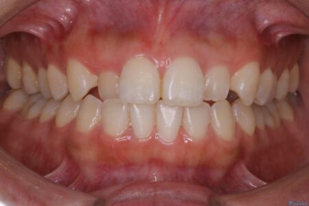 【20代女性】軽度の反対咬合を部分矯正でなおす 治療前