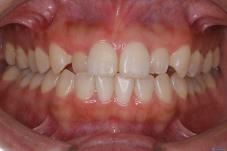 【20代女性】軽度の反対咬合を部分矯正でなおす 治療前画像