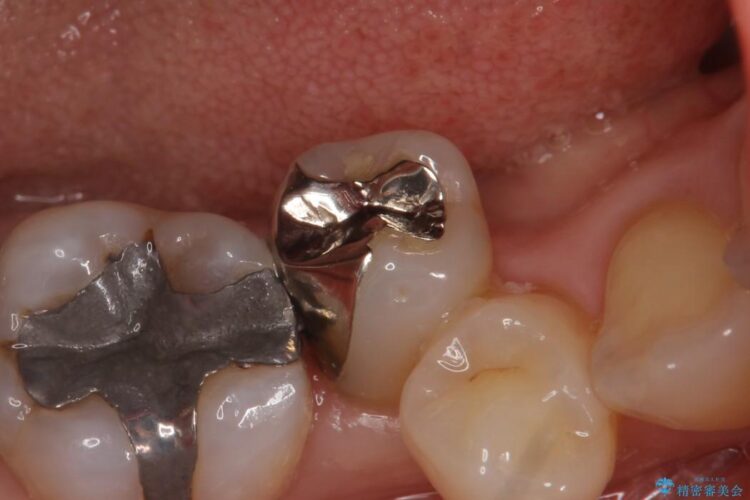 【50代女性】銀歯を見た目のきれいなセラミックに 治療前画像