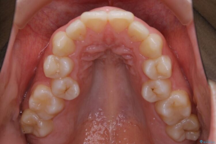 【20代女性】口元を引っ込めたい Eラインの改善 治療前画像