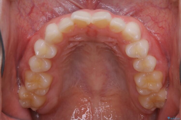 【20代女性】短期間でのインビザライン治療で見た目の悩みを改善する 治療前画像