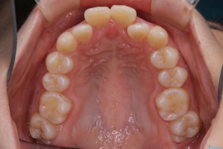 【20代女性】抜歯矯正で出っ張った口元を改善する 治療前画像