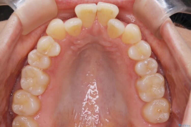 【30代女性】短期間で非抜歯による反対咬合(受け口)の改善 治療前画像