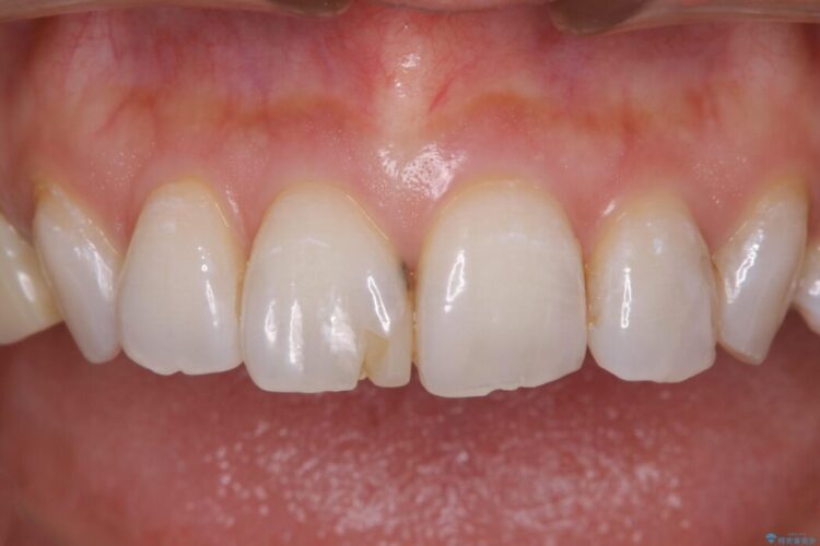 【30代女性】前歯の見た目をセラミッククラウンで変える 治療前画像