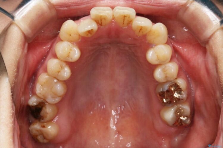 【20代女性】開咬の隙間と歯列の凸凹をまとめて改善する 治療前画像