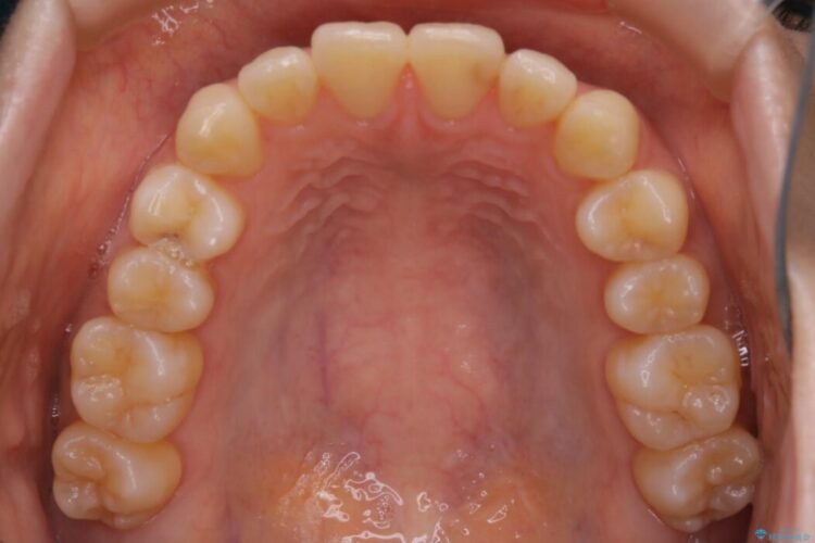 【20代女性】気になる部分だけをマウスピース矯正 治療前画像