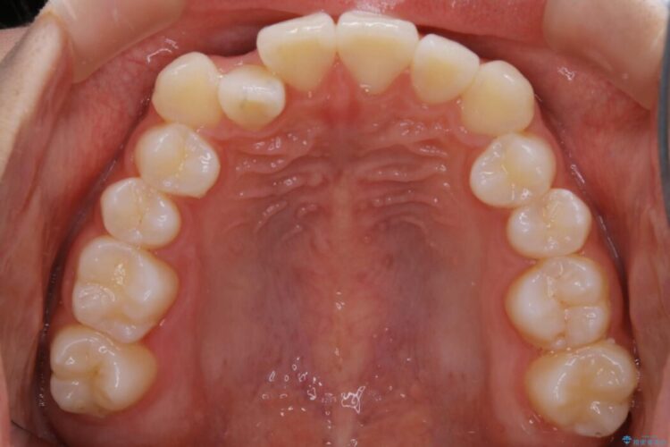 【10代女性】早めに始める受け口（反対咬合）の矯正治療 治療前画像