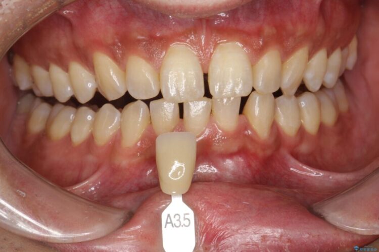 【30代男性】ホワイトニングでできる限り白くしたい 治療前画像