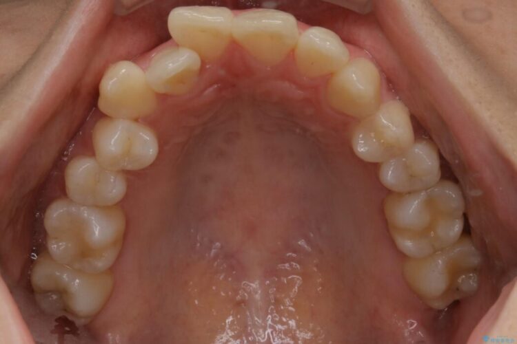 【20代女性】非抜歯でもガタガタを改善するインビザライン矯正 治療前画像