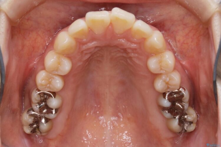 【20代女性】非抜歯でマウスピースの限界に挑戦する矯正治療 治療前画像