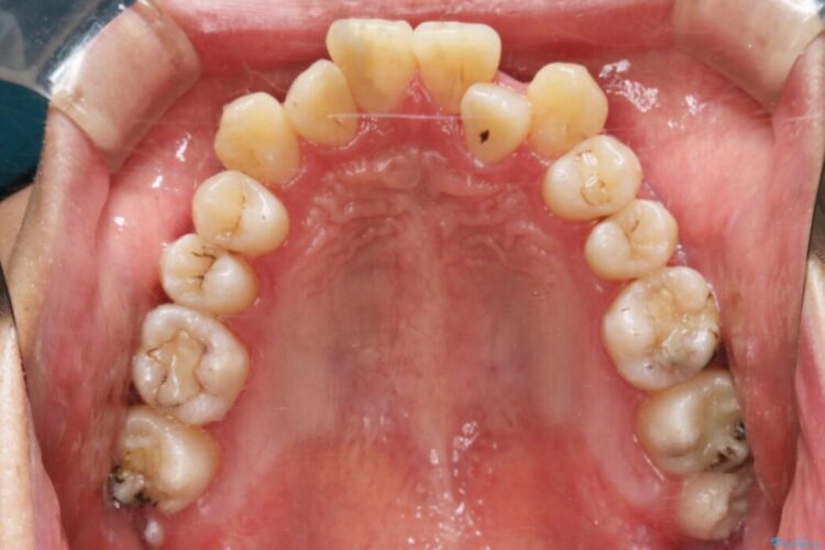 【20代男性】上顎のガタガタな歯列をインビザラインで矯正治療 治療前画像