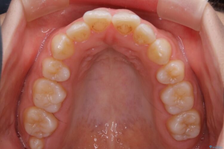 【20代女性】前歯が噛み合わない!開咬（オープンバイト）の矯正治療 治療前画像