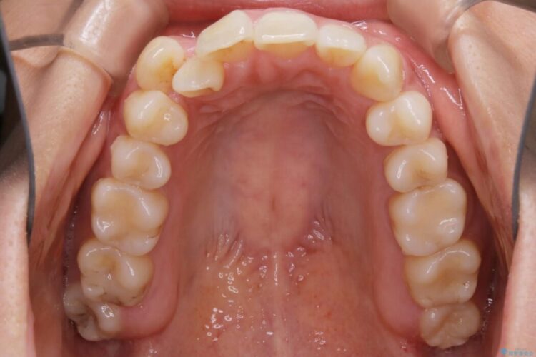 【20代女性】隠れた前歯とガタつきをきれいな歯列弓へ 治療前画像