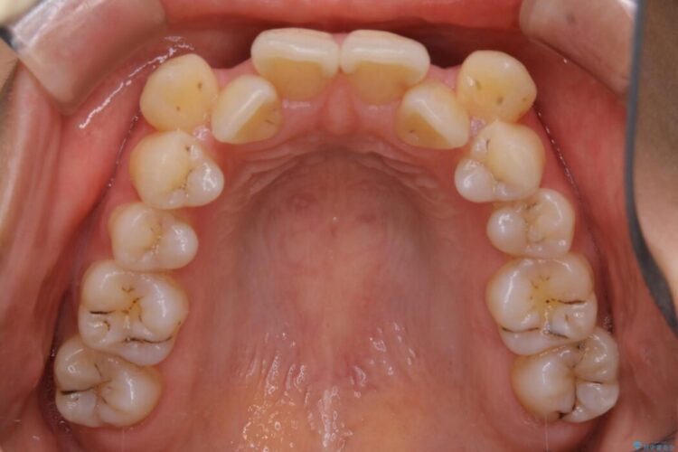 【20代女性】抜歯ワイヤー矯正で八重歯がスッキリ 治療前画像