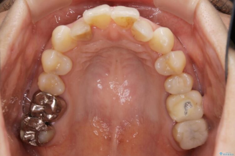【30代女性】前歯の反対咬合をマウスピースで改善 治療前画像