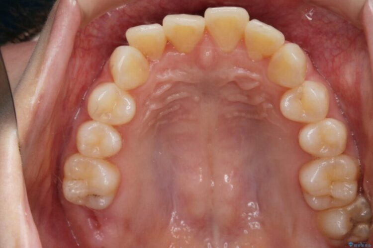 【20代女性】ブライダルに向けた矯正できれいなスマイルラインへ 治療前画像