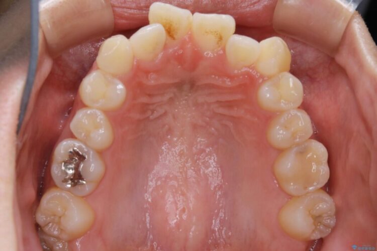 【20代女性】前歯の真ん中（正中）のズレとガタつきを効率よく矯正する 治療前画像