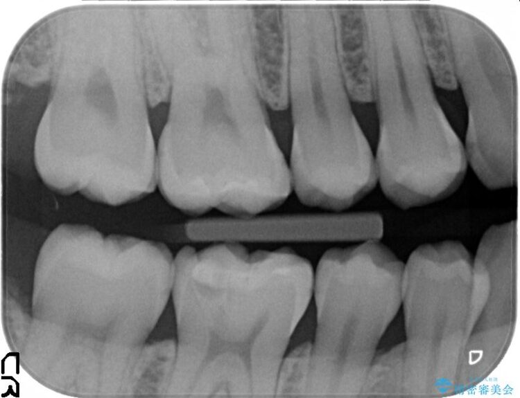 【20代女性】黒ずんだ虫歯をとり白い歯へ 治療前画像