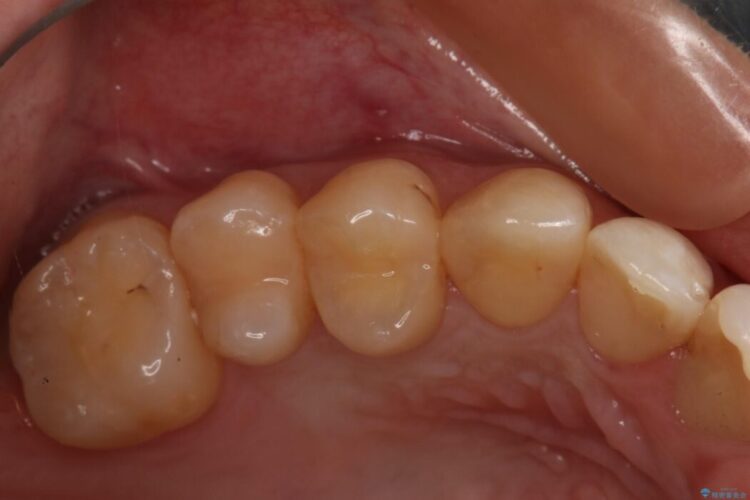 【20代 女性】劣化した保険のプラスチックをセラミックへ 治療前画像