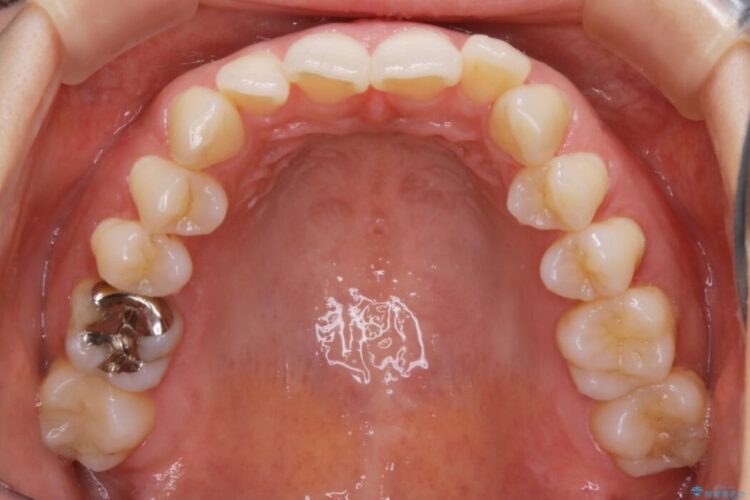 【30代女性】非抜歯で噛み合わせとガタつきの改善 治療前画像