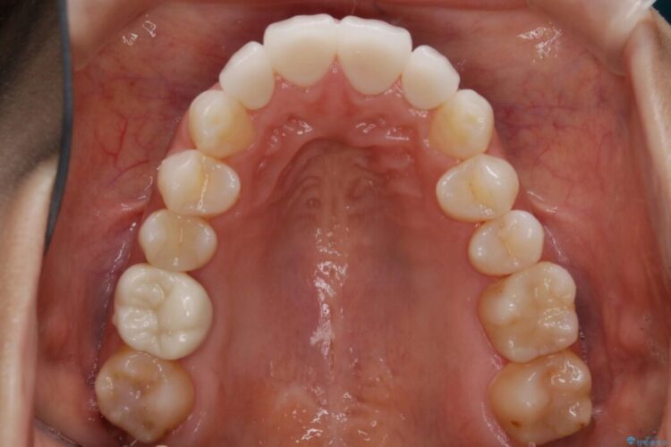 【30代女性】噛み合わせのズレを解消する 治療前画像