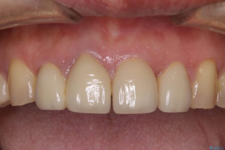 【50代男性】前歯の被せ物を新しく 治療前画像