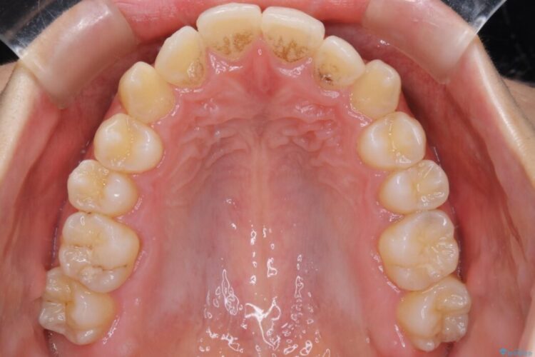 【20代女性】噛み合わせの歪みを超短期間でインビザライン治療 治療前画像