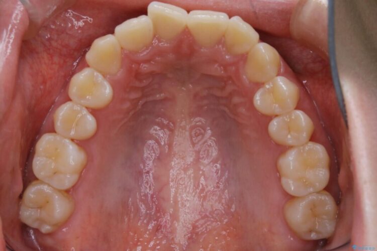 【20代女性】噛み合わせのズレからくるガタついた歯列をインビザライン矯正治療 治療前画像
