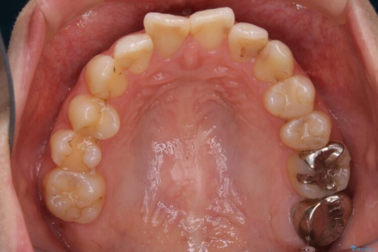 【20代女性】非抜歯で歯列をコンパクトに 治療前画像