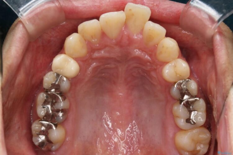 【20代男性】出っ歯をインビザラインで矯正治療 治療前画像