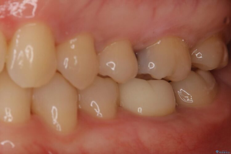 【30代女性】黒ずんだ虫歯をセラミック治療 治療前画像